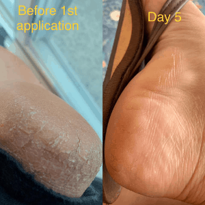 cracked heels before and after