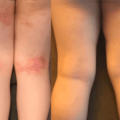 How To Soothe Eczema in Children