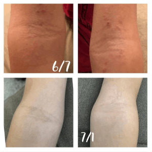 atopic dermatitis before and after