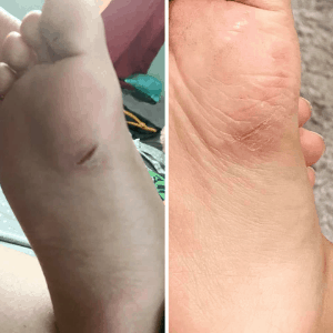 MIG lotion bar before and after of boy's cracked foot