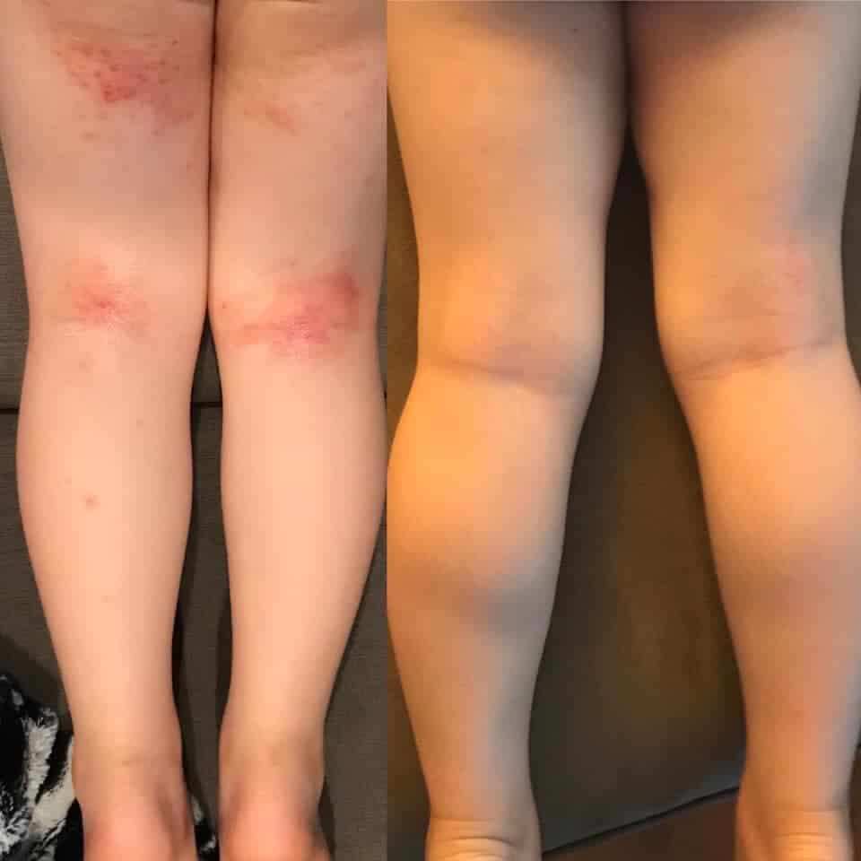 eczema on child's legs before and after